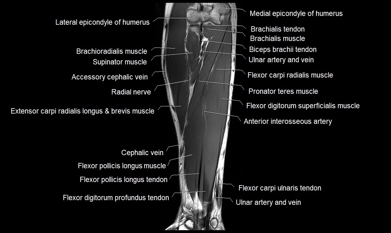 MRI 3T forearm coronal cross sectional anatomy image 10.webp